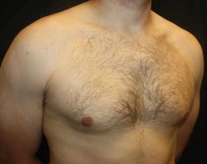 Gynecomastia Before & After Patient #21239