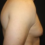 Gynecomastia Before & After Patient #21239