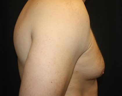 Gynecomastia Before & After Patient #21239