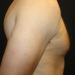 Gynecomastia Before & After Patient #21239