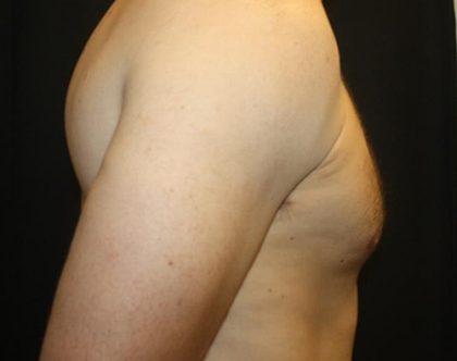 Gynecomastia Before & After Patient #21239