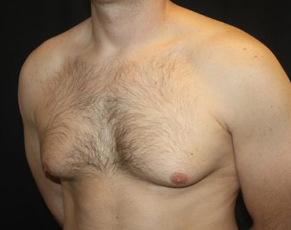 Gynecomastia Before & After Patient #21239