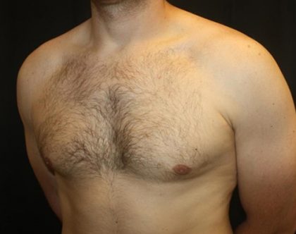 Gynecomastia Before & After Patient #21239