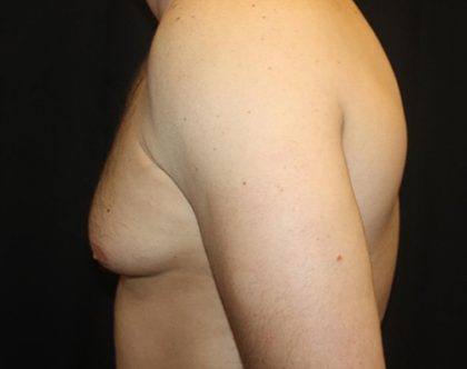 Gynecomastia Before & After Patient #21239