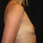 Breast Augmentation - Round Silicone Implants Before & After Patient #20366