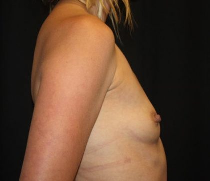 Breast Augmentation - Round Silicone Implants Before & After Patient #20366