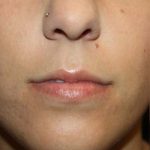 Lip Augmentation Before & After Patient #21657