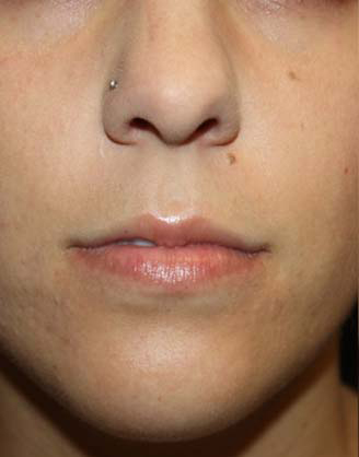 Lip Augmentation Before & After Patient #21657