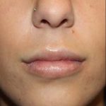 Lip Augmentation Before & After Patient #21657