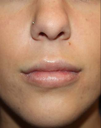 Lip Augmentation Before & After Patient #21657