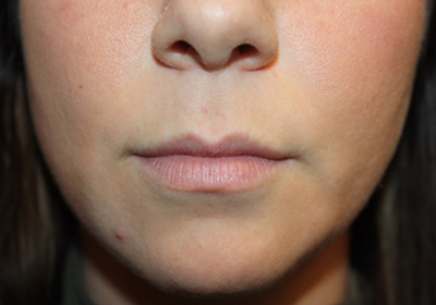 Lip Augmentation Before & After Patient #21660