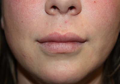 Lip Augmentation Before & After Patient #21660