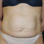 Tummy Tuck Before & After Patient #21546