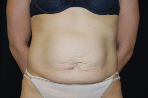 Tummy Tuck Before & After Patient #21546