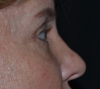 Blepharoplasty Before & After Patient #20131
