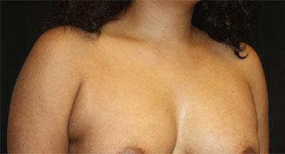 Axillary Breast Tissue – Removal Before & After Patient #20019