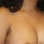 Axillary Breast Tissue – Removal Before & After Patient #20019