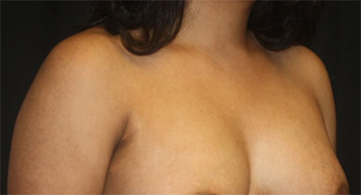 Axillary Breast Tissue – Removal Before & After Patient #20019