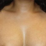 Axillary Breast Tissue – Removal Before & After Patient #20019