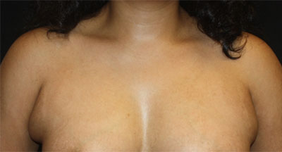 Axillary Breast Tissue – Removal Before & After Patient #20019