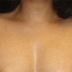 Axillary Breast Tissue – Removal Before & After Patient #20019