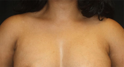 Axillary Breast Tissue – Removal Before & After Patient #20019