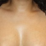 Axillary Breast Tissue – Removal Before & After Patient #20019