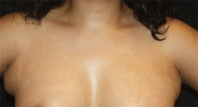 Axillary Breast Tissue – Removal Before & After Patient #20019