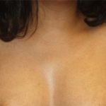 Axillary Breast Tissue – Removal Before & After Patient #20019