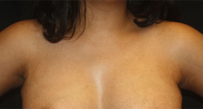 Axillary Breast Tissue – Removal Before & After Patient #20019