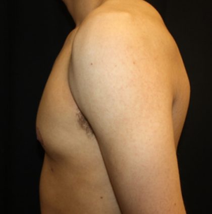Gynecomastia Before & After Patient #23455