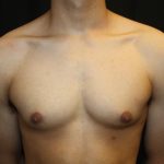 Gynecomastia Before & After Patient #23455