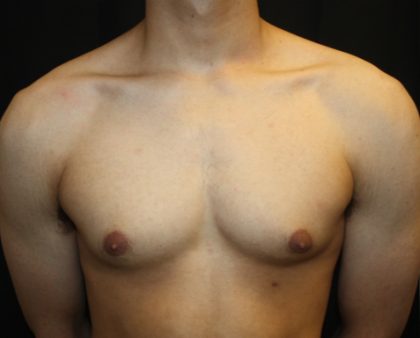 Gynecomastia Before & After Patient #23455