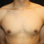 Gynecomastia Before & After Patient #23455