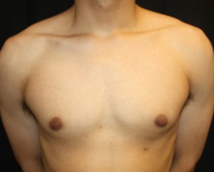 Gynecomastia Before & After Patient #23455