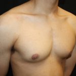 Gynecomastia Before & After Patient #23455