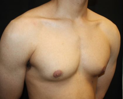 Gynecomastia Before & After Patient #23455