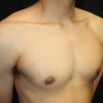 Gynecomastia Before & After Patient #23455