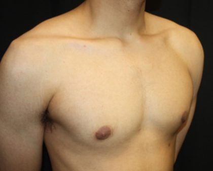 Gynecomastia Before & After Patient #23455