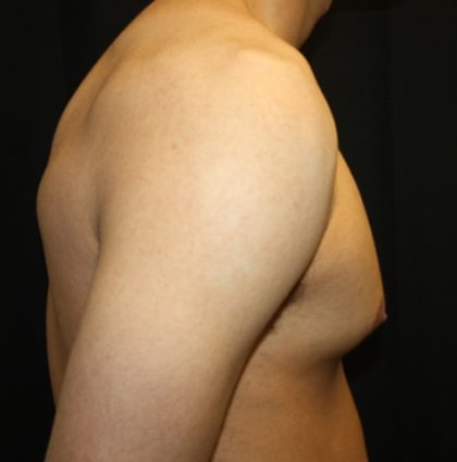 Gynecomastia Before & After Patient #23455