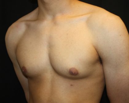 Gynecomastia Before & After Patient #23455