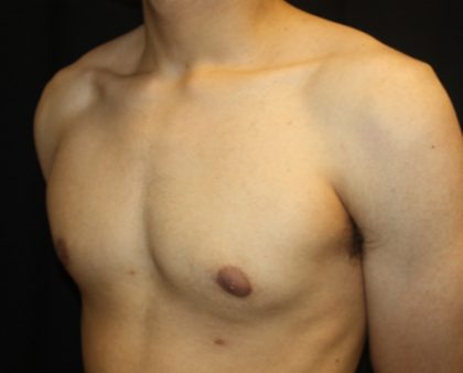 Gynecomastia Before & After Patient #23455