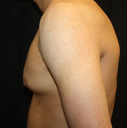 Gynecomastia Before & After Patient #23455