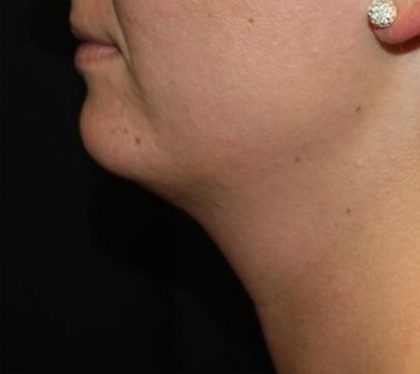 Kybella Before & After Patient #19907