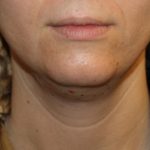 Kybella Before & After Patient #19907