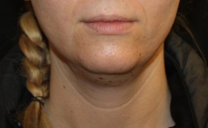 Kybella Before & After Patient #19907