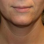 Kybella Before & After Patient #19907