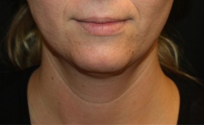 Kybella Before & After Patient #19907