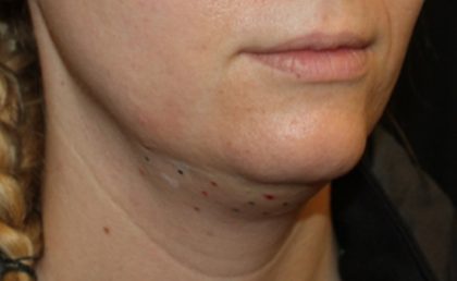 Kybella Before & After Patient #19907
