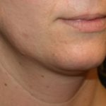 Kybella Before & After Patient #19907